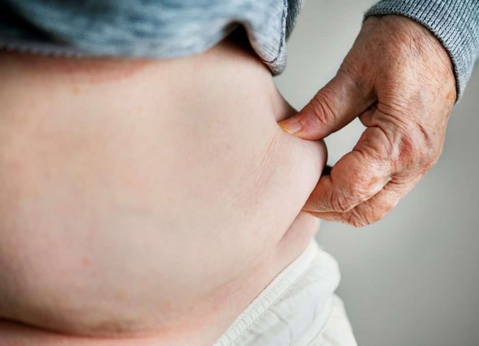 Managing Stomach stretch post gastric sleeve surgery - Dr Ravi Rao, Perth, Western Australia