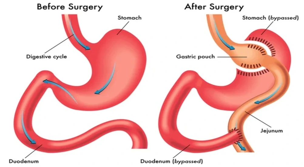 Gastric Bypass surgery how long does it take?